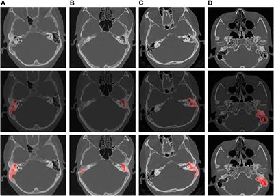 An automatic diagnosis model of otitis media with high accuracy rate using transfer learning